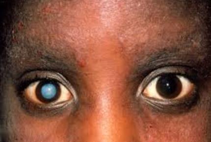 بیماری های چشمی-مجله مادر ک وکودگوپی