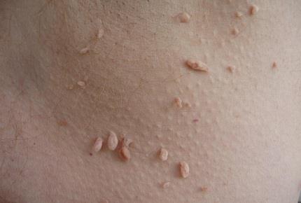 فراوانی دیابت در بیماران مبتلا به Skin tag