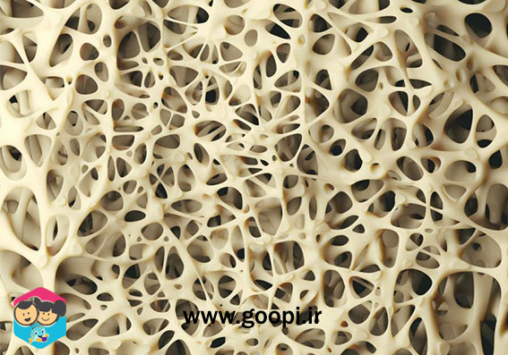 پوکی استخوان القاء شده توسط دارو - مجله گوپی