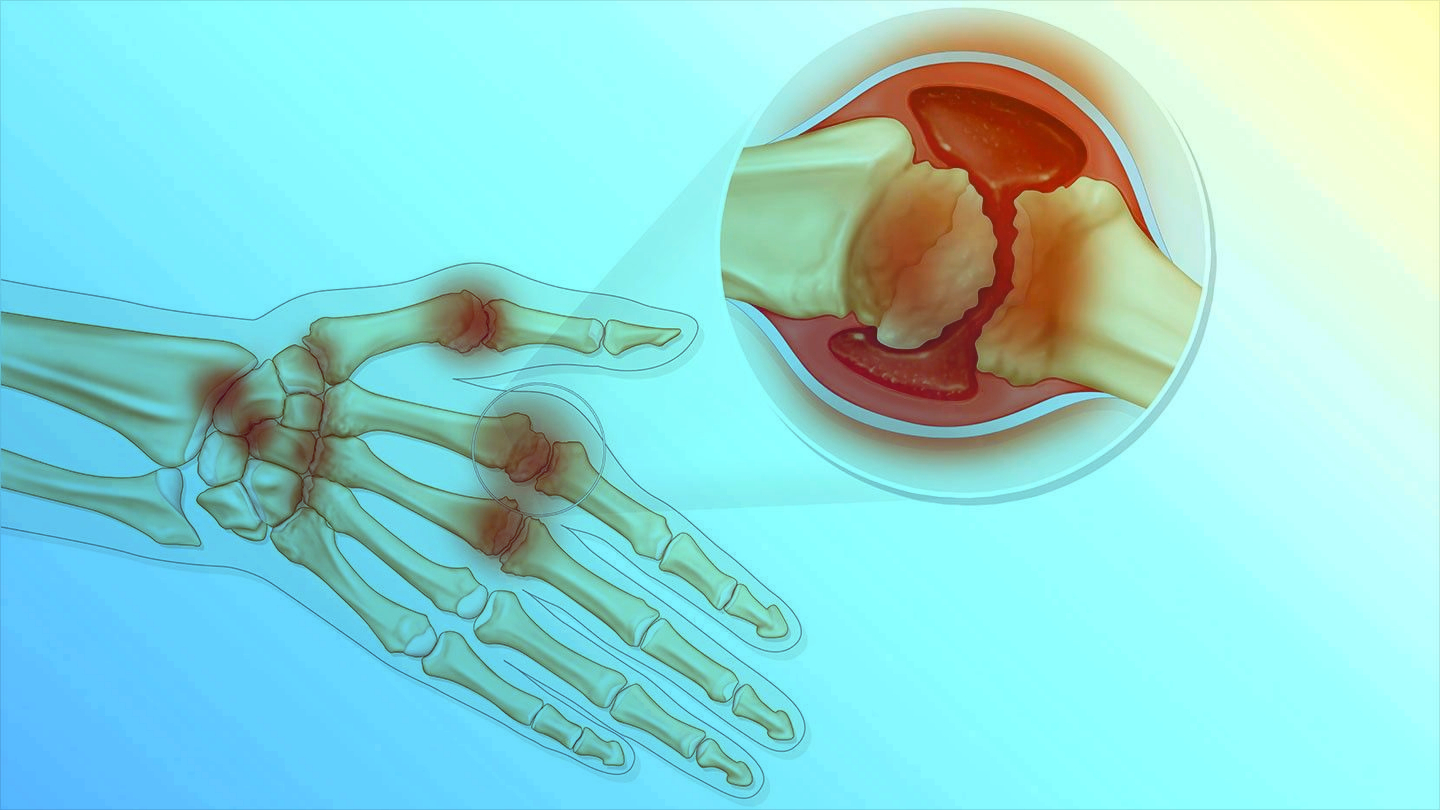 آرتریت روماتویید  شایع ترین بیماری التهابی مفاصل