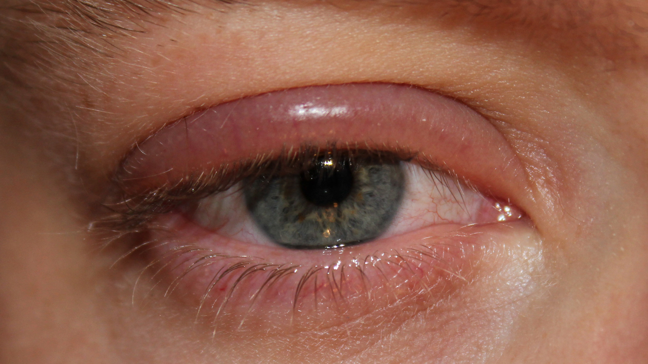 عفونت  چشمی