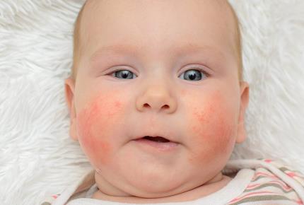 پوست نوزاد: نشان های پوستی