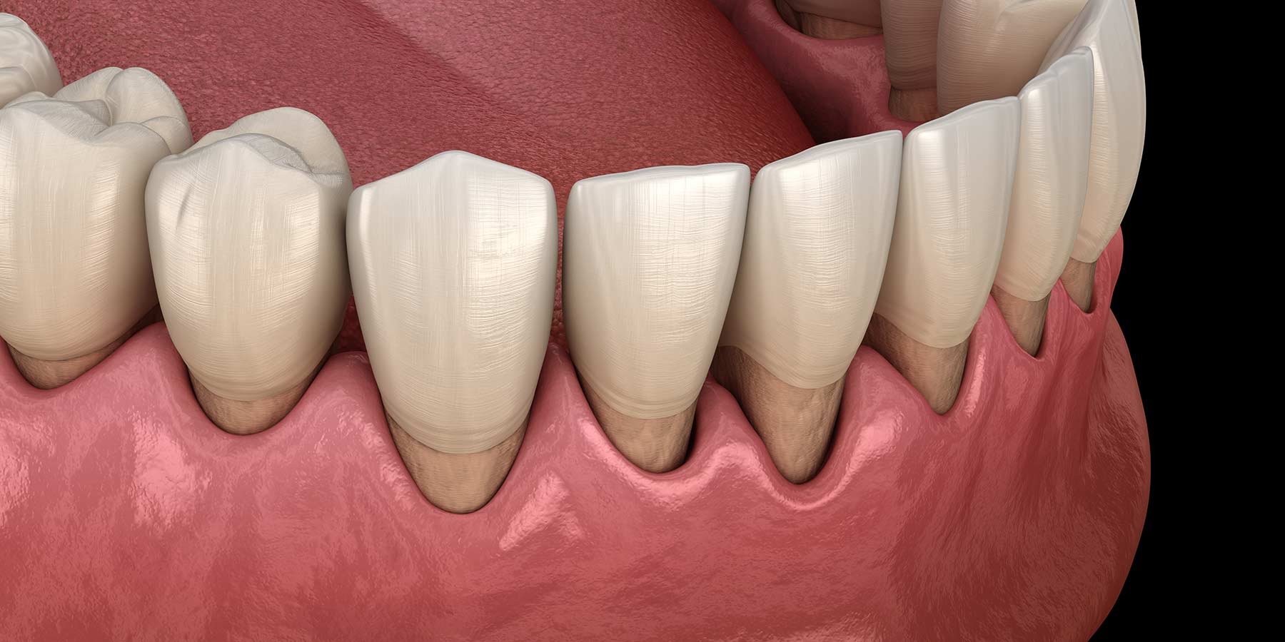 بررسی رابطه بین بیماریهای پریودنتال و تنفس دهانی