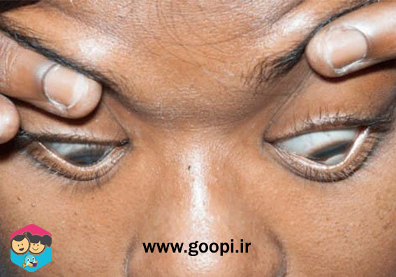 بیماریهای چشمی کراتوکونوس - goopi.ir