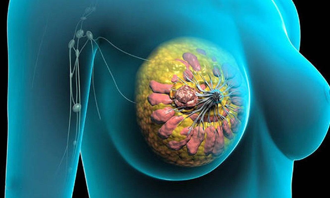 رشد بالای ابتلای زنان به سرطان سینه چه دلایلی دارد؟- مجله مادر گوپی