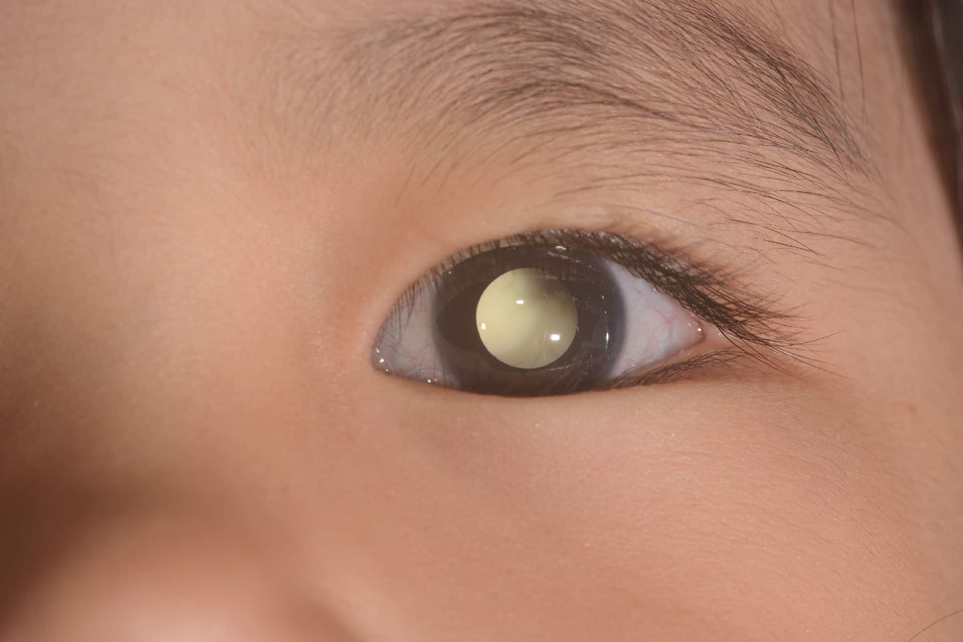 تومور بدخیم درون چشمی در اطفال