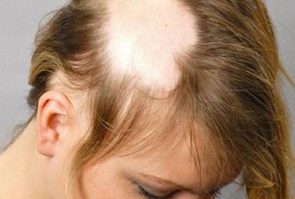 آلوپسی آراآتا، بیماری ریزش منطقه ای مو- مجله مادر گوپی