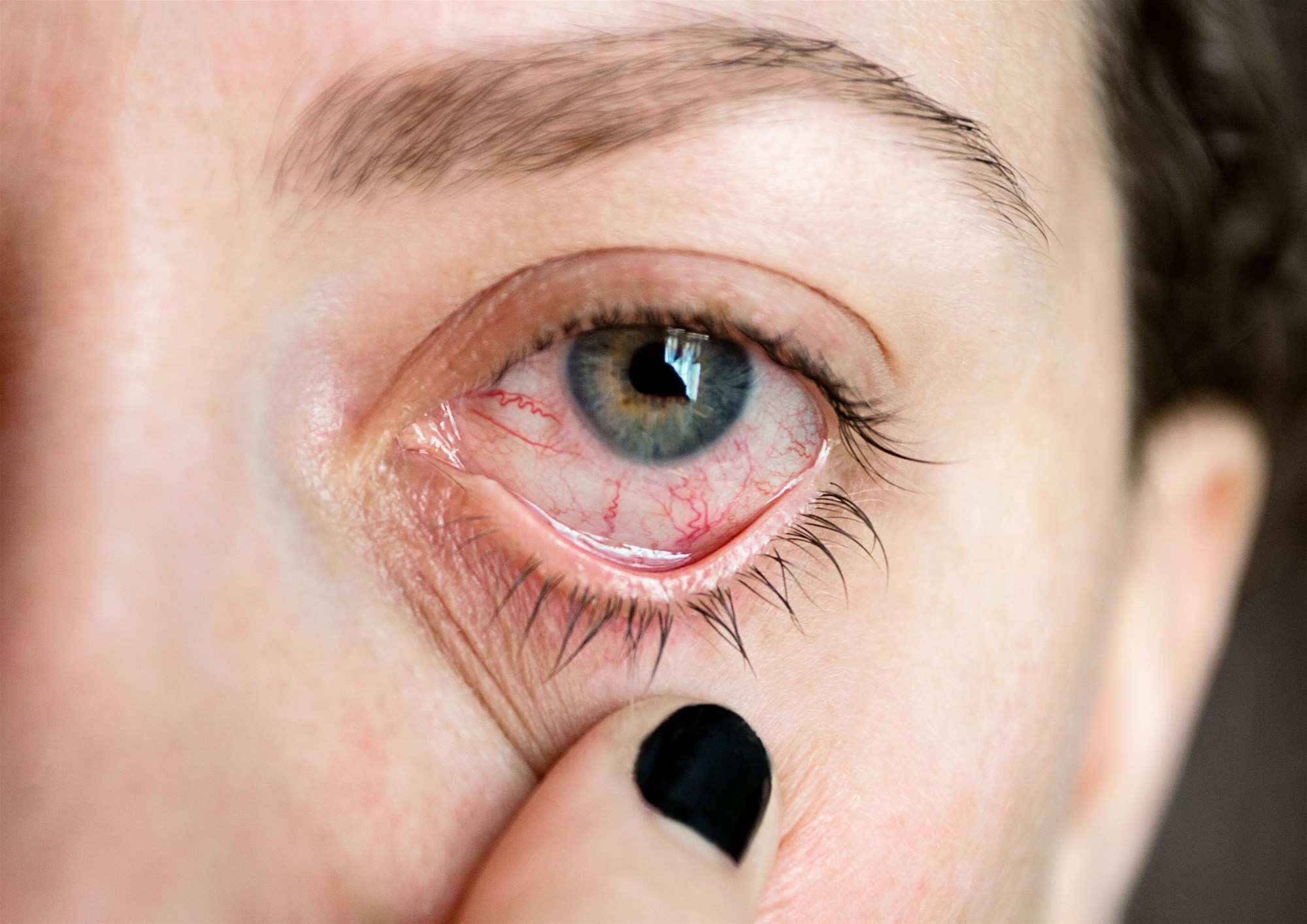 علل و عوامل ایجادکننده قرمزی چشم