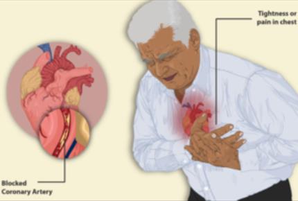 انژین صدری چیست و چگونه با آن برخورد کنیم؟