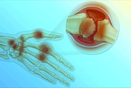 آرتریت روماتویید  شایع ترین بیماری التهابی مفاصل