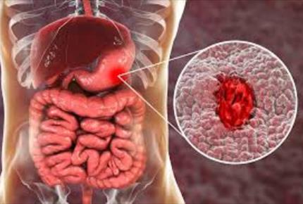 زخم در دستگاه گوارش-مجله مادر گوپی