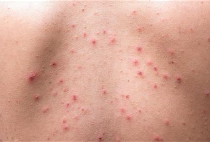 بیماری های پوستی شایع فصل تابستان از دیدگاه متخصصین پوست