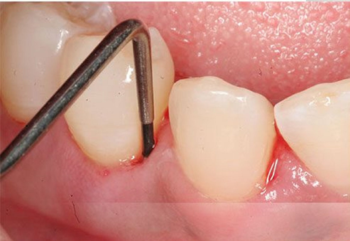 بیماریهای لثه ( پریو )بیماریهای بسیار خطرناک دندانی- مجله مادر گوپی