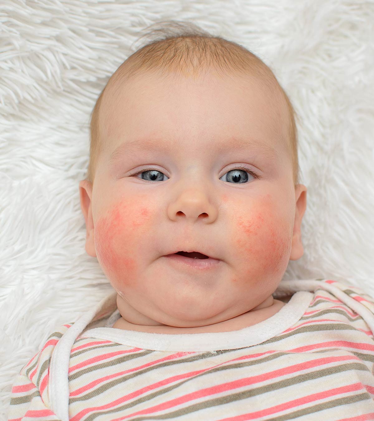 پوست نوزاد: نشان های پوستی