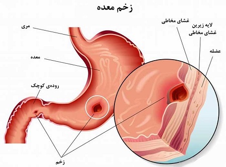 بررسی اثرات سایمتیدین در بیماران مبتلا به سوء هاضمه بدون زخم